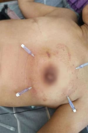 乳腺增生的套针综合治疗