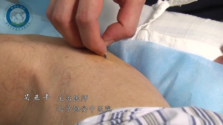 套针治疗腰椎间盘突出症 — 吴亚平教授（世中联套针专委会高峰论坛）